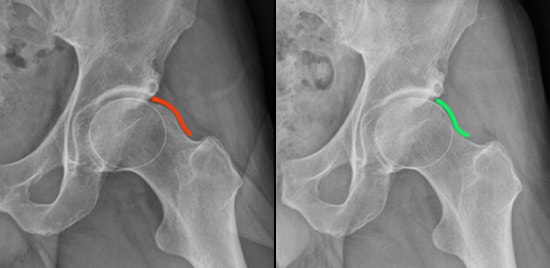 Arthroscopic Procedure of the Hip